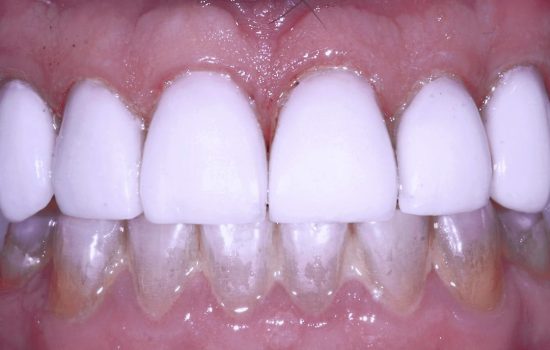 image of teeth after veneers