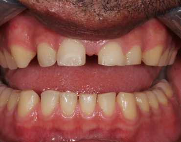 Dental Veneers Before Tijuana 01