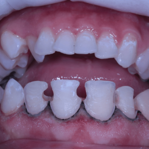 Dental Veneers Before Tijuana 02