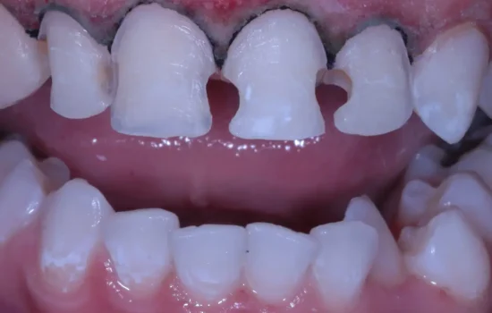 Dental Veneers Before Tijuana 02