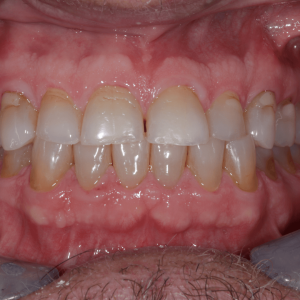 Dental Veneers Before Tijuana 03