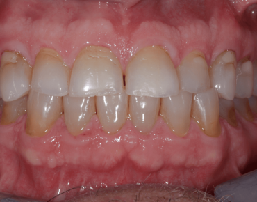 Dental Veneers Before Tijuana 03