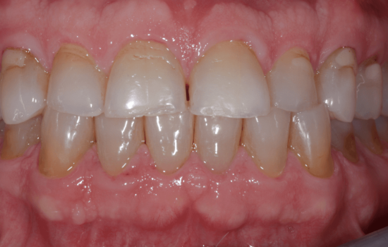 Dental Veneers Before Tijuana 03