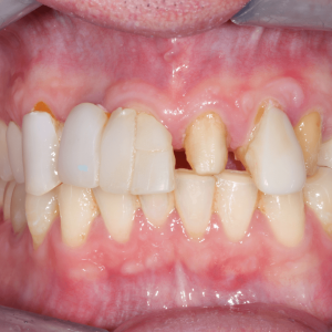 Dental Veneers Before Tijuana 04