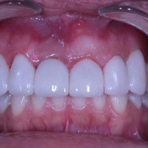 Dental Implants and Crowns After 02