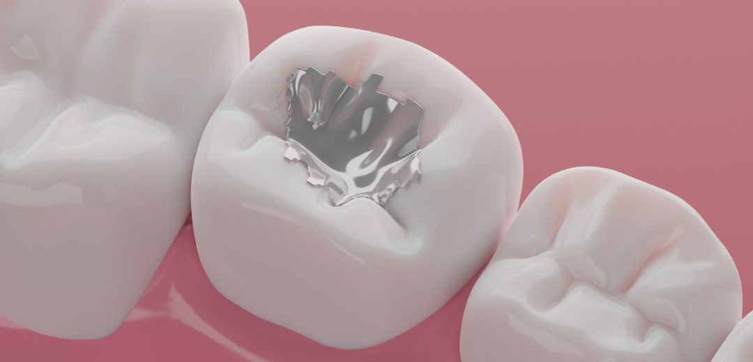 Mercury Amalgam Fillings