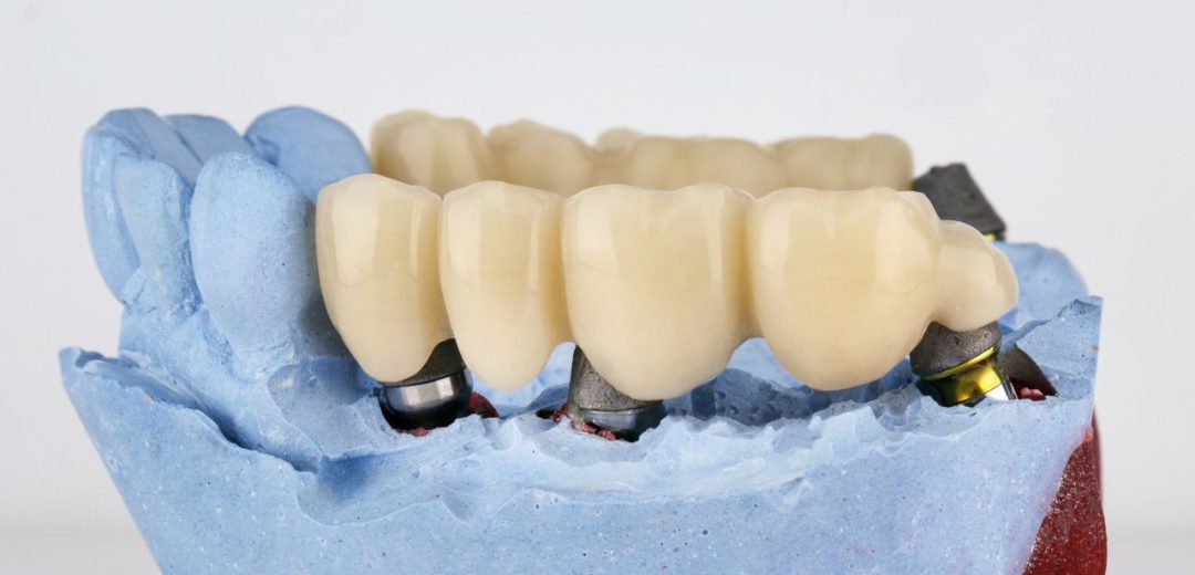 Missing Tooth Dental Bridge