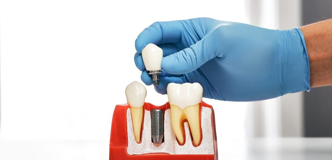 Missing Tooth Dental Implants