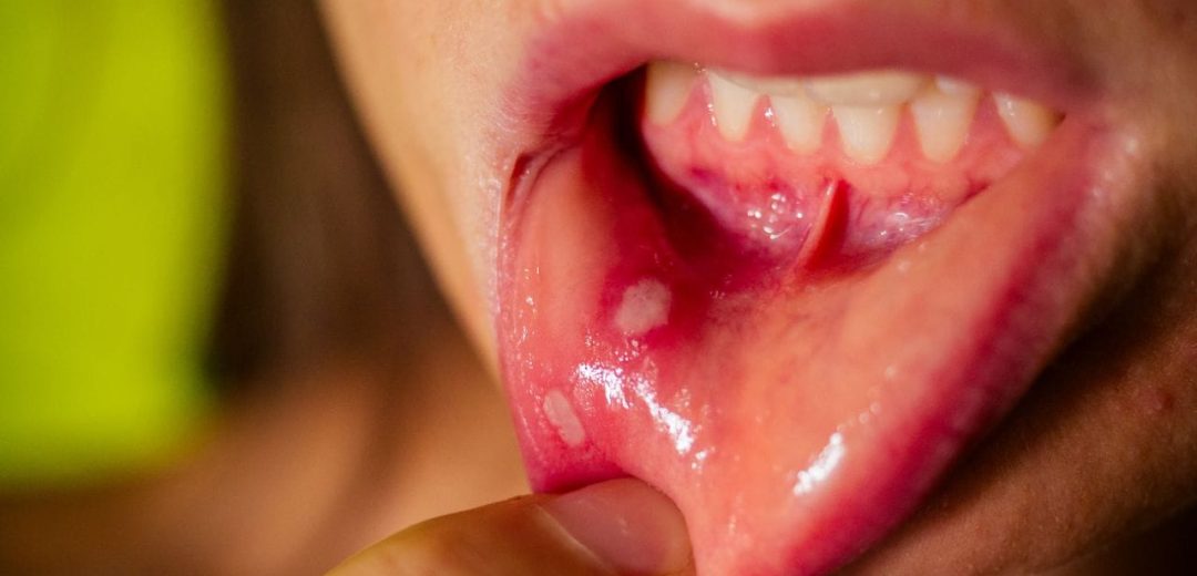 Mouth Ulcers