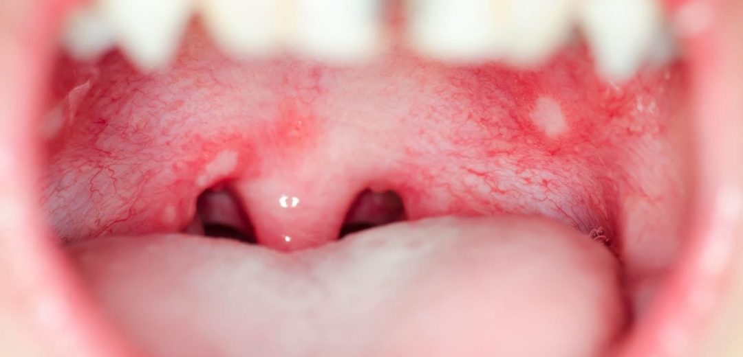 Mouth Ulcers