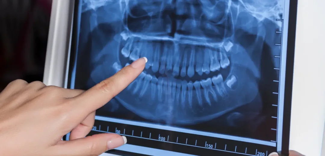 Osteitis Dental Bone Inflamation