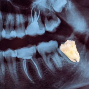 Image of Dental extraction