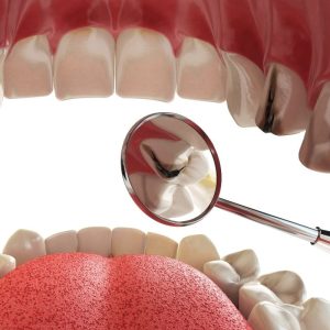 image of phase 1 consultation dental implant in tijuana