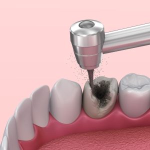 Demo Root canal procedure in tijuana