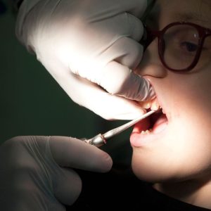 Image of Dental extraction