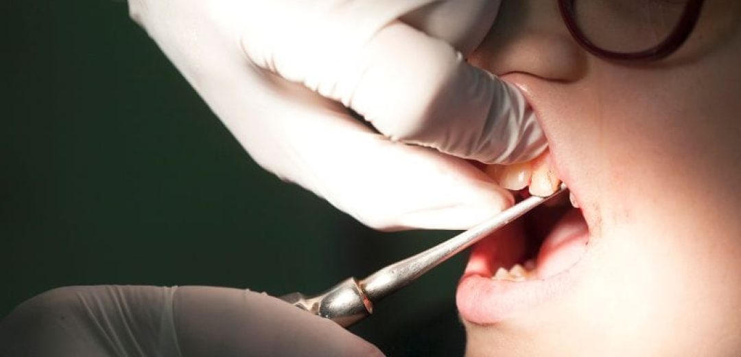 Image of Dental extraction