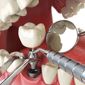 image of teeth after a dental implant