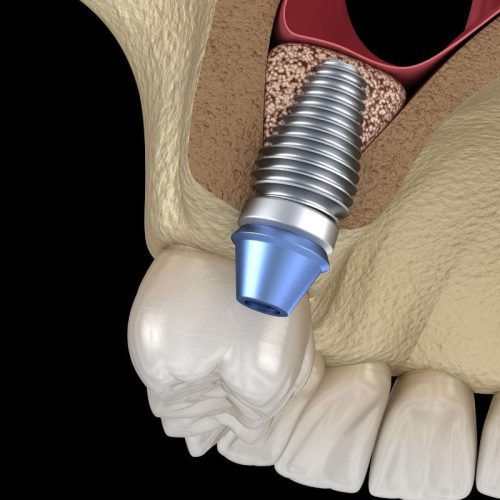 Phase 3 Bone Graft