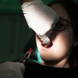 Image of Dental extraction