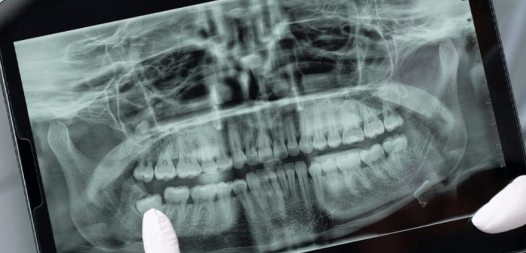 Root Canal Diagnosis root canal dentist near me