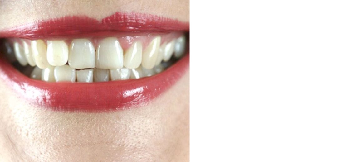 Dental Veneers Shavin 04