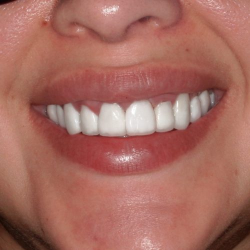 Close up women smiling with good denture after all on4 dental implants