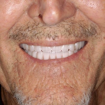 Dental Implants in Tijuana dentures near me