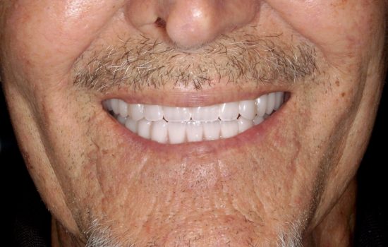 Dental Implants in Tijuana