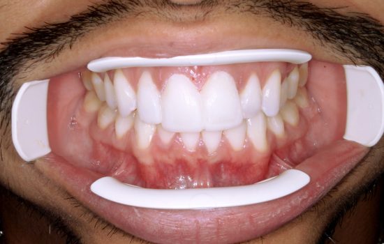 Best Teeth Whitening Tijuana