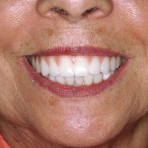 close up women smiling with a exellent denture