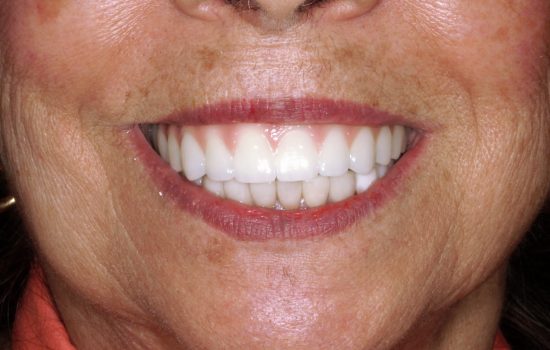 close up women smiling with a exellent denture