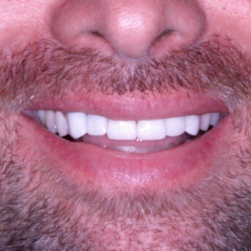 Best Teeth Whitening Tijuana