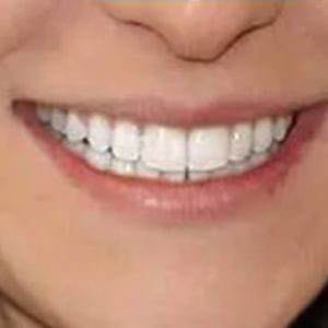 young girl close up of tooth smile with perfect denture