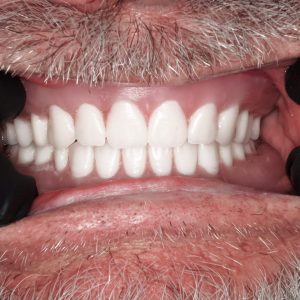 Image of teeth after veneers