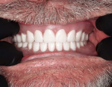 Image of teeth after veneers