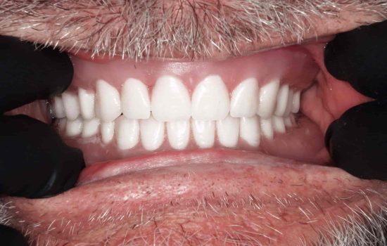 Image of teeth after veneers