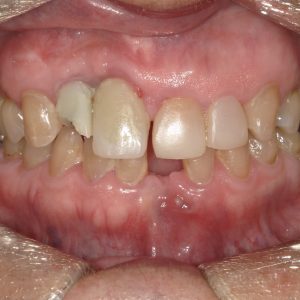 Image of teeth after veneers