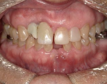 Image of teeth after veneers