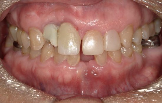 Image of teeth after veneers