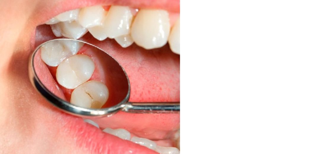 What are Dental Sealants