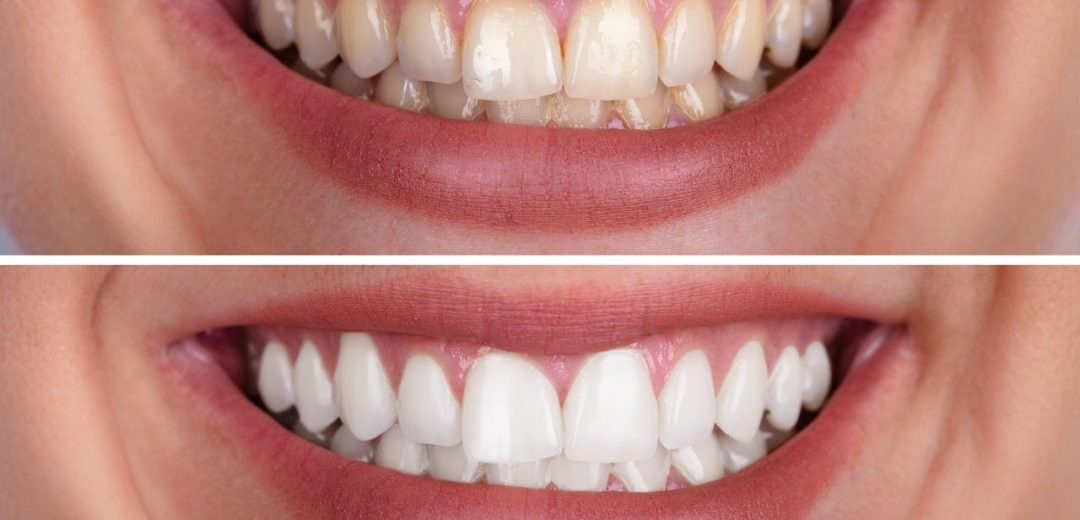 Yellow Teeth Treatment