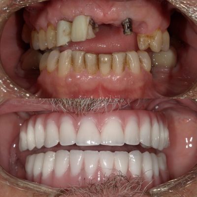 all-on-4 dental implants teeth in a day