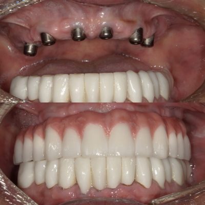 all-on-4 dental implants