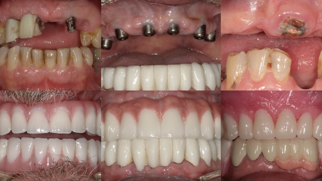 all-on-4 dental implants all-on-4 dentures