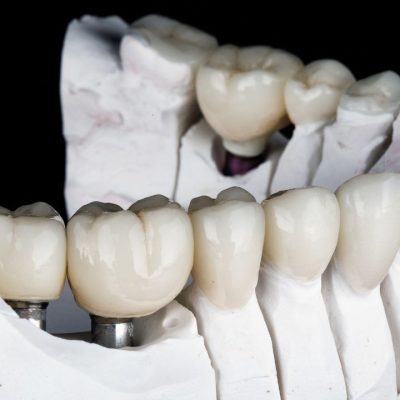 dental crowns and veneers