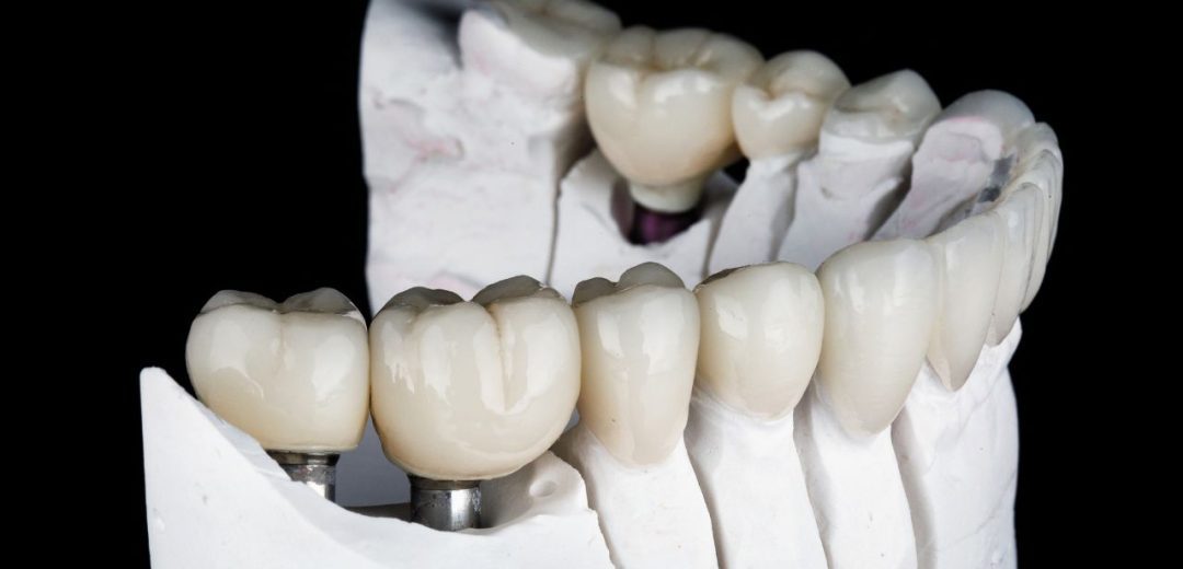 dental crowns and veneers