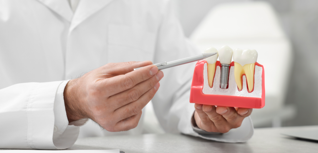 dental implants Types of Implants