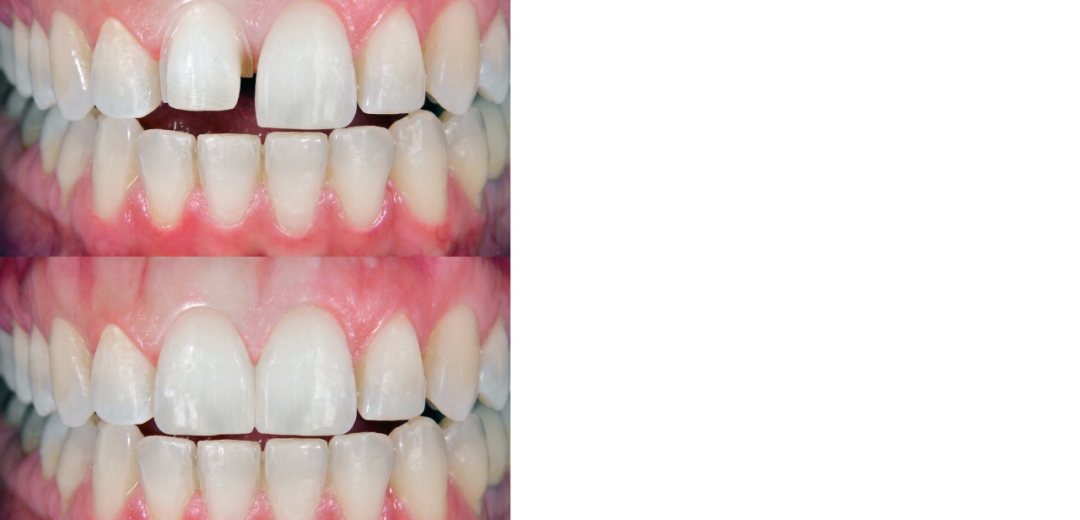 face shape veneers