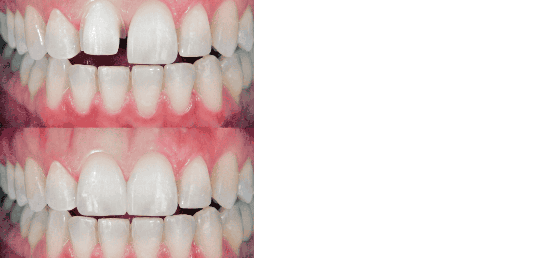 face shape veneers