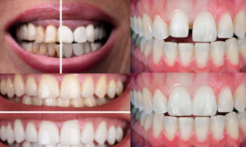 mexican dentist near me Cosmetic porcelain veneers walk in dentist mear me